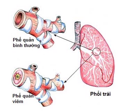 Phân biệt viêm phế quản mạn tính và bệnh phổi tắc nghẽn mạn tính như thế nào?